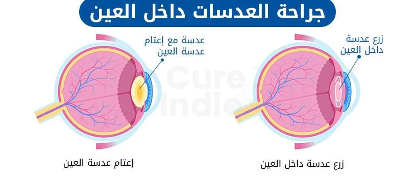 عملية زراعة عدسة داخل العين في الهند